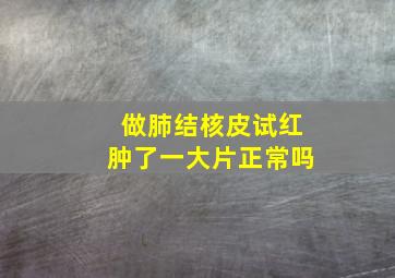 做肺结核皮试红肿了一大片正常吗