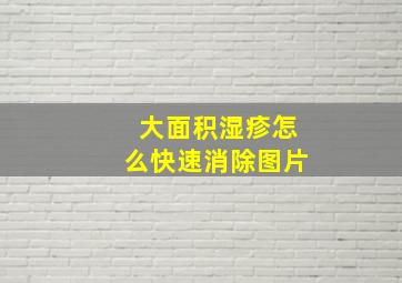 大面积湿疹怎么快速消除图片