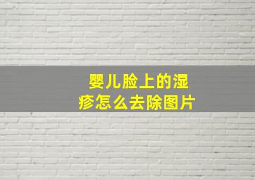 婴儿脸上的湿疹怎么去除图片