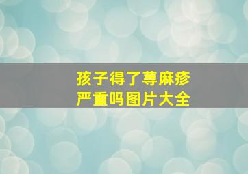 孩子得了荨麻疹严重吗图片大全