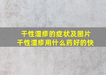 干性湿疹的症状及图片干性湿疹用什么药好的快