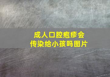 成人口腔疱疹会传染给小孩吗图片