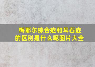 梅耶尔综合症和耳石症的区别是什么呢图片大全