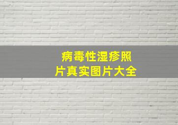 病毒性湿疹照片真实图片大全