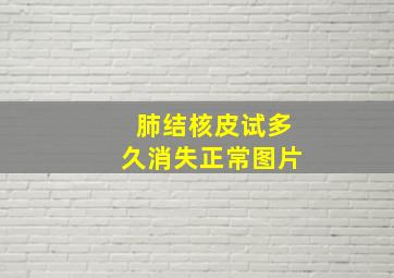 肺结核皮试多久消失正常图片