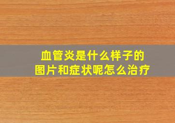 血管炎是什么样子的图片和症状呢怎么治疗