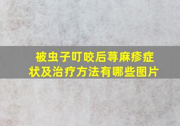 被虫子叮咬后荨麻疹症状及治疗方法有哪些图片