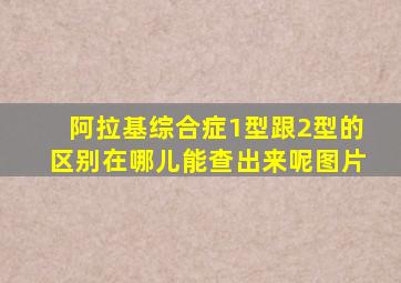 阿拉基综合症1型跟2型的区别在哪儿能查出来呢图片