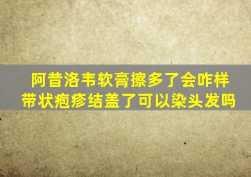 阿昔洛韦软膏擦多了会咋样带状疱疹结盖了可以染头发吗