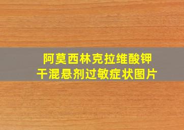 阿莫西林克拉维酸钾干混悬剂过敏症状图片