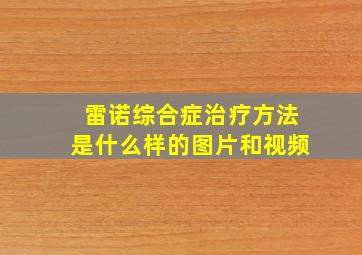 雷诺综合症治疗方法是什么样的图片和视频