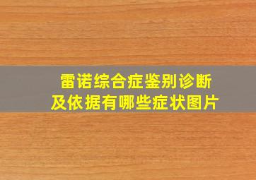 雷诺综合症鉴别诊断及依据有哪些症状图片