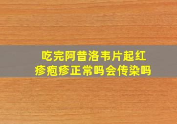 吃完阿昔洛韦片起红疹疱疹正常吗会传染吗