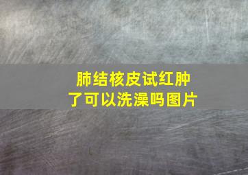 肺结核皮试红肿了可以洗澡吗图片