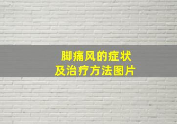 脚痛风的症状及治疗方法图片